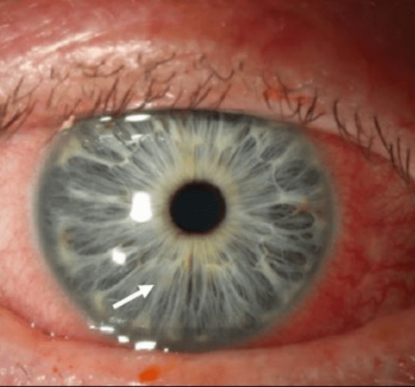 Corneal Ulcer - ABDO